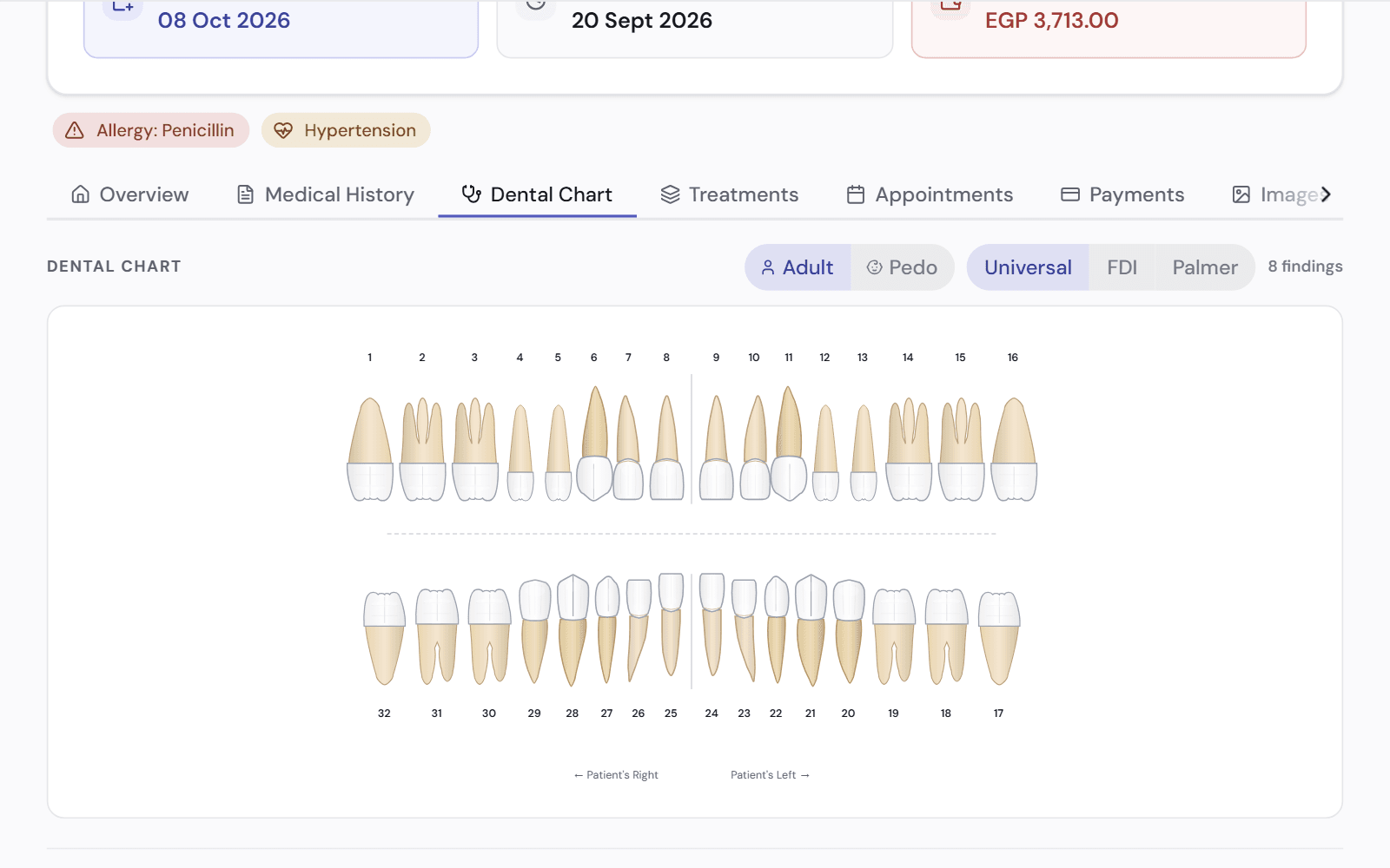 A patient's file on the dental chart tab: Allergy: Penicillin and Hypertension flags above a full adult odontogram, with switches for Universal, FDI and Palmer numbering.