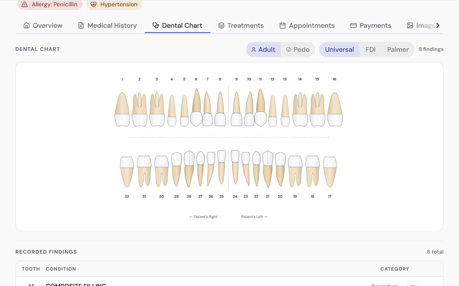 A full adult dental chart with switches for adult or child teeth and for Universal, FDI or Palmer numbering, above the list of recorded findings.